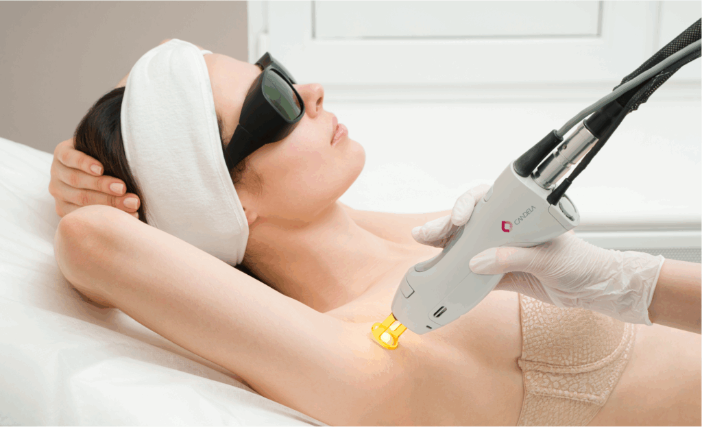 Woman receiving underarms laser hair removal treatment at MiraMed and Day Spa in Santa Barbara
