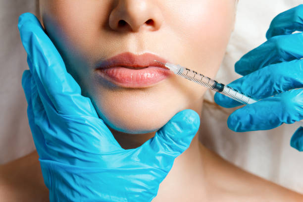 Client receiving half syringe lip filler for natural lip enhancement at MiraMed and Day Spa in Santa Barbara