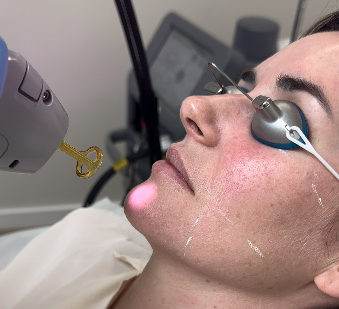 A young woman with acne-prone skin receiving a Candela Laser Facial from a licensed aesthetician in a serene medical spa treatment room.