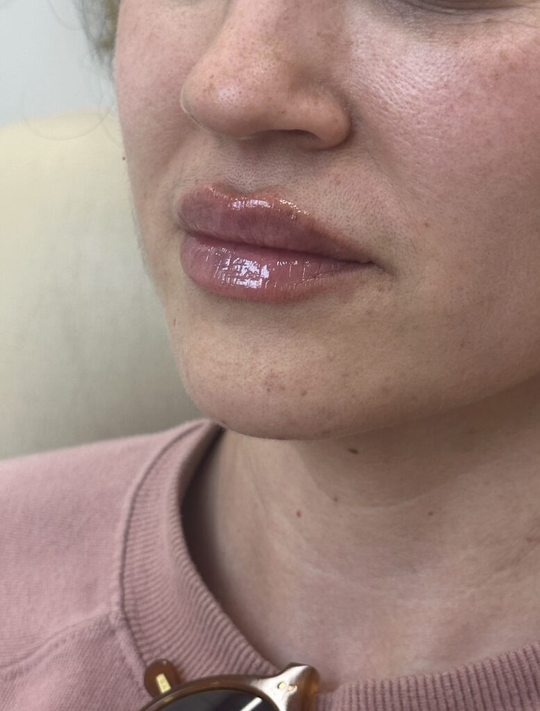 After photo showing fuller plumper lips following lip filler injection results at MiraMed Day Spa Santa Barbara California