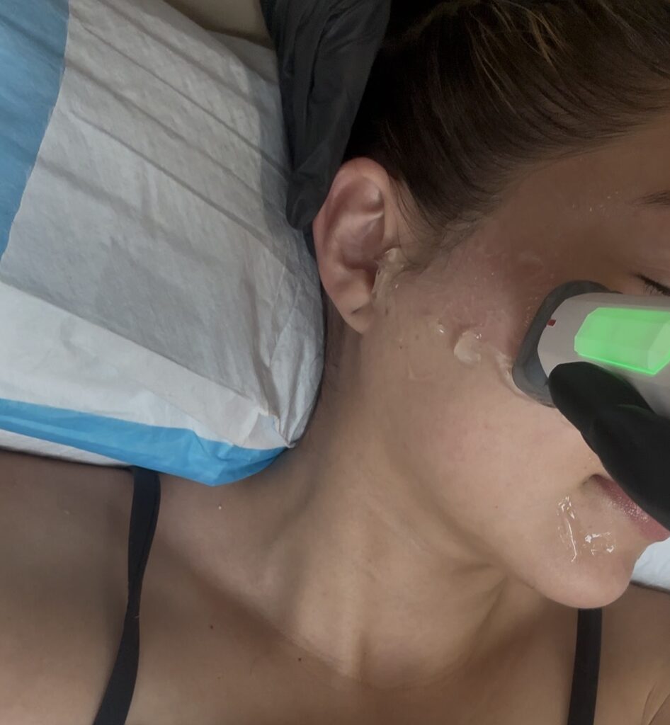 XERF skin tightening results and longevity at MiraMed and Day Spa in Santa Barbara