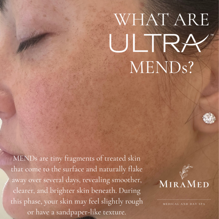 MENDs after LaseMD Ultra laser resurfacing at MiraMed in Santa Barbara