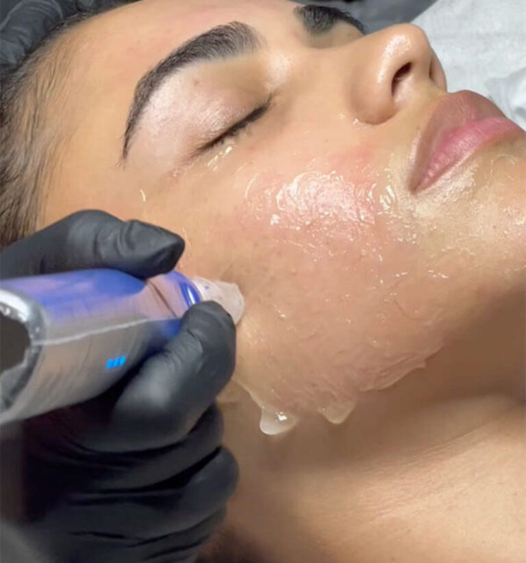 SkinPen microneedling treatment at MiraMed in Santa Barbara
